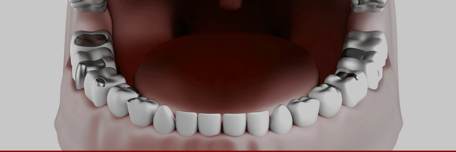 Can Supplements Help You Detoxify from Amalgam Poisoning from Mercury Dental Almalgams?
