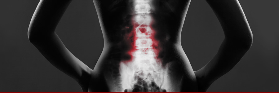 Can Supplements Help With Ankylosing Spondylitis?